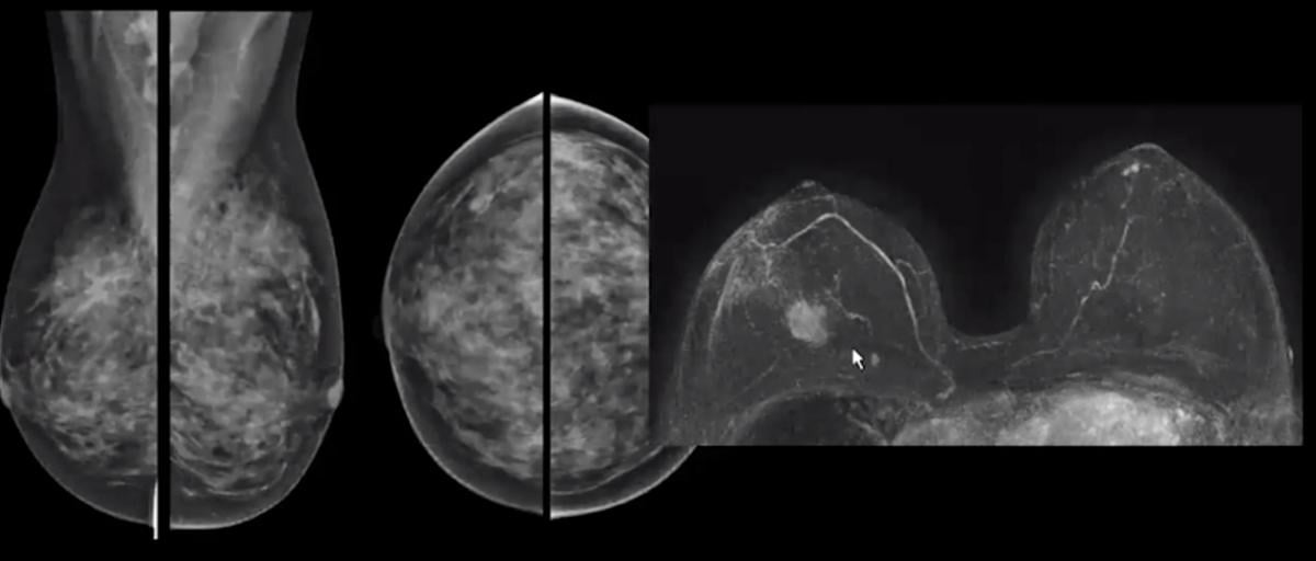 Use of Breast MRI Screening in Women With Dense Breasts | Imaging 